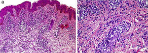 Histological examination of a biopsy specimen taken from an indurated border of one plaque, hematoxylin–eosin stain (a) superficial and deep perivascular and interstitial infiltrate, without epidermal changes (Hematoxilina-Eosina 80X). (b) The deep dermal infiltrate was composed predominantly of neutrophils, with abundant nuclear dust, without other signs of vasculitis (Hematoxilina-Eosina 100X).