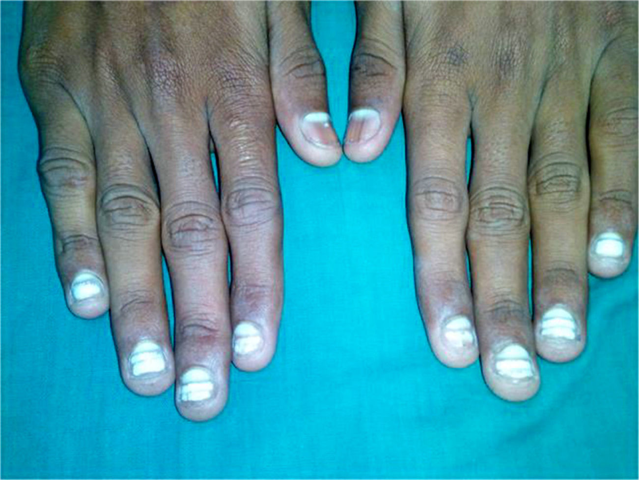 Idiopathic Acquired Leukonychia Totalis of the Fingernails in a Child ...