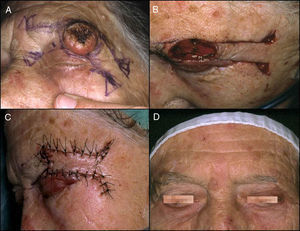 A, Keratoacanthoma in the area of the left eyebrow. B, Excision of the lesion and design of a quadrangular advancement flap with Burow triangles at the base to cover the defect created. C, Result immediately after suturing the flap with 3/0 silk. D, Final result, showing symmetry of the eyebrows and alopecia of the tail of the left eyebrow.