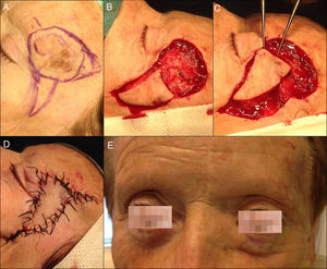 A, Asymmetric pigmented plaque in the left temporal region,with a non-homogeneous network in its superior portion; a diagnosis of lentigo maligna melanoma was made on the incisional biopsy. B and C, Excision of the lesion with 5mm surgical margins and design of an advancement-rotation flap with a subcutaneous pedicle island flap from the left malar region. D, Result immediately after suturing with 3/0 and 4/0 silk. E, Result 1 month after the operation.