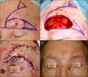 A, Recurrence of a basal cell carcinoma that affected the whole of the body of the left eyebrow. B, Defect left by excision of the lesion. C, Reconstruction using a superior rotation flap of the forehead, with a tension-releasing Burow triangle. D, Result 1 month after surgery.