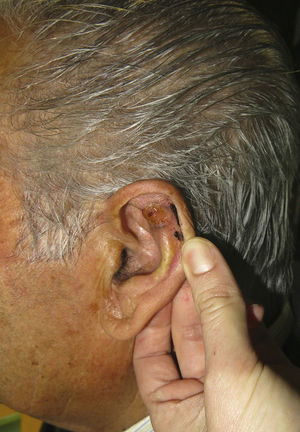 Ulcerated adenoid basal cell carcinoma measuring 1.8×1.5cm.
