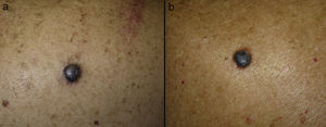 A, A pigmented nodular lesion of 10mm diameter that had appeared on the right shoulder of a 54-year-old man 8 months earlier. B, A pigmented nodular lesion of 12mm diameter in the left scapular region of a 67-year-old woman; the patient was uncertain when the lesion had first appeared but reported that it had grown rapidly in recent months.
