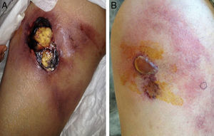 A, Indurated erythematous plaque with a central ulcer on the anterior aspect of the right thigh. B, Indurated erythematous plaque on the lateral aspect of the right thigh; there is a central blister of serous fluid with a necrotic base.