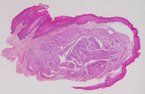Histopathology revealed a clearly-circumscribed submucosal tumor (hematoxylin and eosin, original magnification×2).