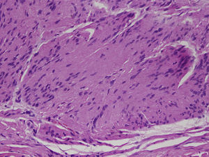 Cells grouped in palisade, forming the structures called Verocay bodies (hematoxylin and eosin, original magnification×20).