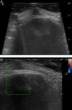 A, B-mode: clearly defined, hypoechoic lesion with no acoustic enhancement or shadow, located in the dermis, without affecting bone. B, Color Doppler: This did not reveal vascularity within or at the periphery of the tumor.