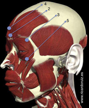 Injection at point 2 can result in the Mephisto effect. Injection at point 3 lifts the lateral portion of the brow; in some patients, it may lift the brow excessively. Injection at point 4 can relax the frontalis muscle; in some patients, it can cause eyelid ptosis. Injection at point 5 can relax the orbicularis oculi muscle and exacerbate the undereye bags.