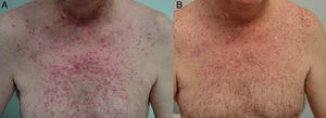 Papulopustular rash before (A) and after (B) treatment with tetracyclines for 2 months. The rash improved after 2 months’ treatment with doxycycline 100mg/d. The rash remained similar in size but improved in terms of severity.