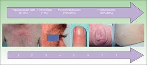 Timeline and frequency of appearance of cutaneous toxicities. The papulopustular rash was the first cutaneous adverse effect to appear, and affected 81.9% of patients. The remaining effects started to appear after a month's treatment, but were less common (11%-40%).