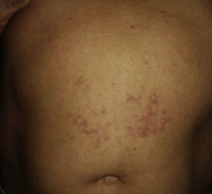 Purpuric-violaceous macular rash with a reticular appearance on the abdomen. Photograph taken 24hours after the dive.