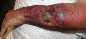 Necrotic 5-cm ulcer surrounded by friable tissue, areas with a lumpy cotton-like appearance, and swelling of the forearm and dorsum of the left hand.