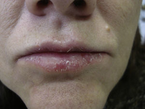 Chronic eczematous involvement of the lip (presenting complaint).