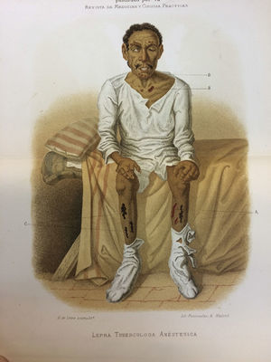 Man with anesthetic tuberculoid leprosy.