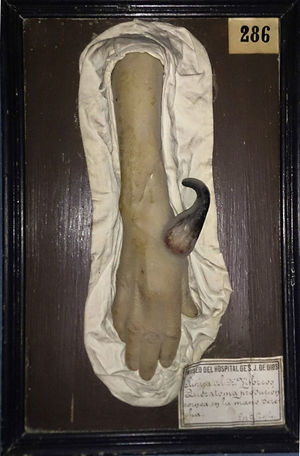 Wax figure of a keratoma (cutaneous horn).