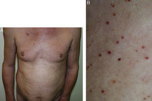A, Multiple papules distributed symmetrically on the trunk and tops of the limbs of the patient. B, Detail of the lesions: rounded or ovulated, nonscaling, nonconfluent brown-red papules with well-defined borders, measuring up to 6mm.