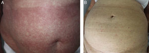 A, Erythematous lesions on the abdomen of a patient with SS before starting treatment with alemtuzumab (case3). B, In the same patient, resolution of the erythema 4 weeks after starting treatment with alemtuzumab.