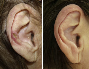 Clinical image of patient 17 before and after treatment.