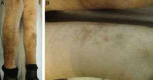 A, Clinical photograph. Symmetrical involvement of both legs, with hyperpigmentation. B, Clinical photograph. Hard, well-defined subcutaneous nodules over which brownish-erythematous macules with a reticular pattern can be observed.