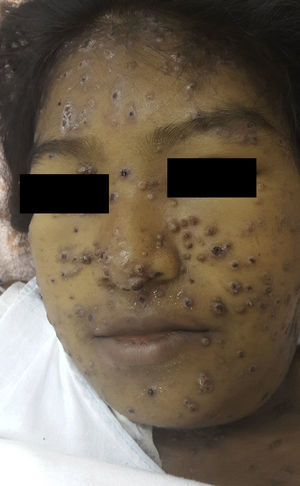 Clinical photograph showing round erythematous-violaceous papules and plaques, some with a central depression and bloodstained scab, on the patient's face. There was also facial edema and jaundice.