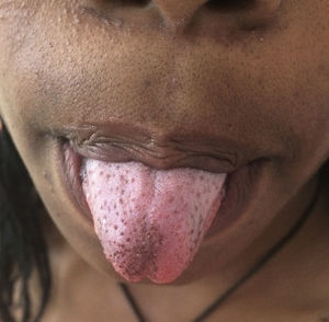 Multiple brown fungiform papillae located on the tip and lateral aspects of the tongue.