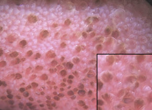 Dermoscopic image showing multiple projections with pigmented borders crossed by vessels branching from the base, creating a rose petal–like appearance.