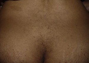 Hypertrichosis on the lower back.