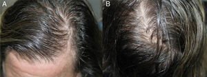 A, Triangular-shaped frontoparietal hairline recession. B, Hair thinning on the crown.