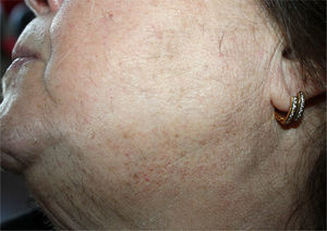 Hirsutism affecting the chin and sides of the face and neck.