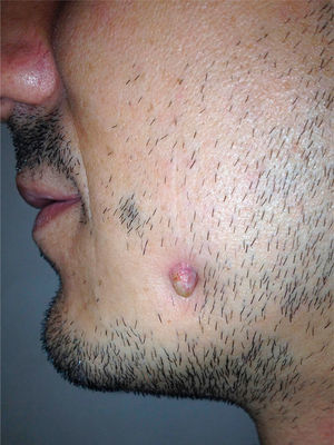 Cutaneous horn sunken into the skin over the left horizontal ramus of the mandible.