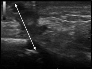 Skin ultrasound (gray scale, longitudinal section): relatively well-defined linear but slightly tortuous hypoechoic structure that reached the surface of the cortical bone of the mandible.