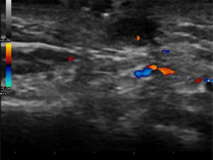 Doppler study showing vascularization of the area around the tract, suggesting inflammation.