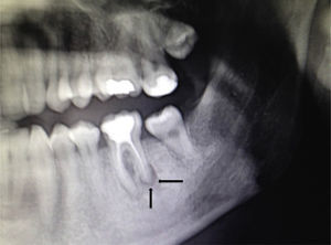Orthopantomography showing a radiolucent image that surrounded the apex of the posterior root of the left first molar.