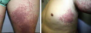 A and B, Similar lesions on both thighs and the trunk (areas not exposed to direct contact with ink).