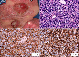 A, Mycosis fungoides in the tumor phase. B, Biopsy (detail) of a tumorous lesion. Note the diffuse large cell lymphoid infiltrate in the dermis (hematoxylin-eosin, original magnification, ×400). C, Immunohistochemical staining showing predominance of CD4+ T lymphocytes (CD4, ×400). D, Expression of CD30 antigen in cells of the lymphoid infiltrate (CD30, ×400).