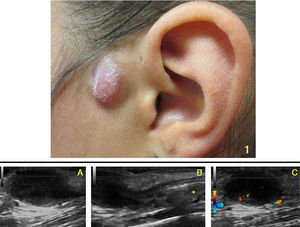 Pink-colored left preauricular tumor adjacent to an orifice. A, Hypoechoic lesion with basal deposits and posterior enhancement. B, The lesion was continuous with a sinus tract, beneath which was an oval lesion with a hyperechoic center and anechoic halo (*). C, Blood vessels in the periphery of the lesion observed in Doppler mode.