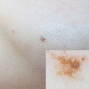 A, Pigmented papule on the left cheek. B, Round, light brown, dark brown, and grayish structures on dermoscopy.