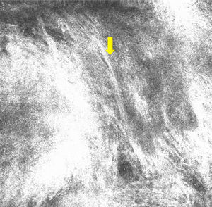 Confocal microscopy image measuring 0.5×0.5mm. Note the polarized nuclei in the epidermis (yellow arrow).
