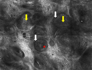 Confocal microscopy image measuring 1×0.75mm. Note the nests of cells (yellow arrow and separation between the stroma and the nests [white arrow]). Peripheral palisading (red asterisk) can be observed in some of the nests.