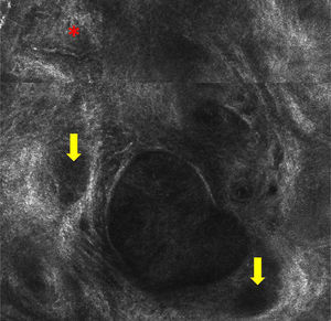 Confocal microscopy image measuring 0.5×0.5mm. Note the hyporeflective nests (yellow arrow) and the large tortuous vessels (red asterisk).
