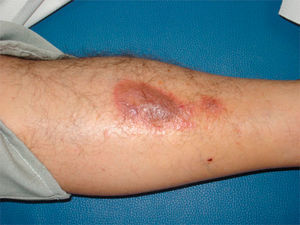 Indurated erythematous-violaceous plaque.