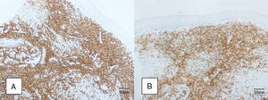 Positive immunohistochemical staining for CD20 (A) and Bcl-2 (B) (original magnification ×20).