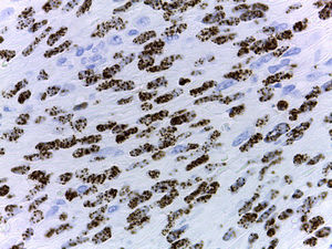 Intranuclear human herpes virus 8 (HVV-8) expression (immunohistochemical HHV-8 stain, original magnification ×40).