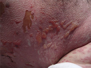 Higher-magnification image showing large superficial blisters and areas of necrosis.