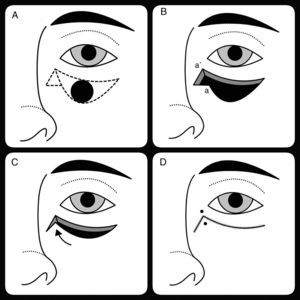 A, Design of the closure; the Burow triangle is designed at the medial end of the incision. B, Anchorage of the ellipse; a to a’ orientation of the first stitch. C, Diagonal movement of the skin. D, Final closure. The points indicate the area of greatest tension when the borders are united.