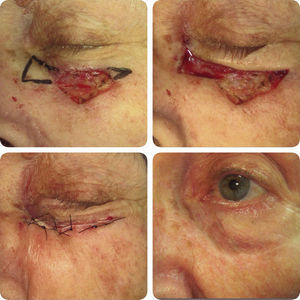 Case 1. Surgical resection of a malignant tumor leaving a defect in the infraorbital region. Closure using a Burow triangle or wedge-shaped resection.