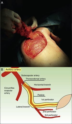 A, Parascapular flap after dissection, attached only by its vascular pedicle. B, Diagram of the blood supply to the area.