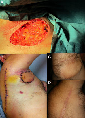 A, Appearance immediately after the en bloc excision of the affected axillary skin, with a surgical margin. B, Surgical wound after removal of the drain 4 days after the operation. C, Healthy axilla 2 years after the operation. D, Partial view of the donor site 2 years after the operation.