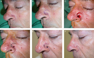 A, Basal cell carcinoma on the left nasal ala. B, Design of a logarithmic spiral flap with a superior pedicle. C, Flap dissected in the subcutaneous plane. D, After medial rotation of the flap, it was sutured using a 4/0 polyglycolic acid suture (Dexon) and 6/0 silk. A small concave area was left open. This healed correctly within a few days by second intention. E, Result at 24hours. F, Appearance at 6 months.