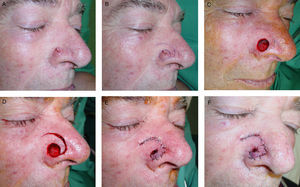 A, Basal cell carcinoma on the lateral surface of the nose. B, Logarithmic spiral flap with a superior pedicle. C, An oval defect was left on the nasal ala. D, The flap was dissected in a deep plane. E, Medial rotation of the flap, parallel to the dorsum of the nose, and suture with a 4/0 polyglycolic acid suture (Dexon) and 6/0 silk. F, Result at 24hours.